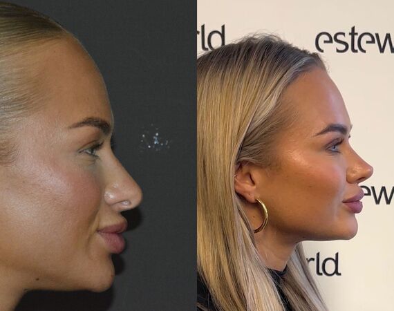 Neuscorrectie Istanbul