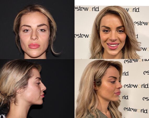 Neuscorrectie Istanbul