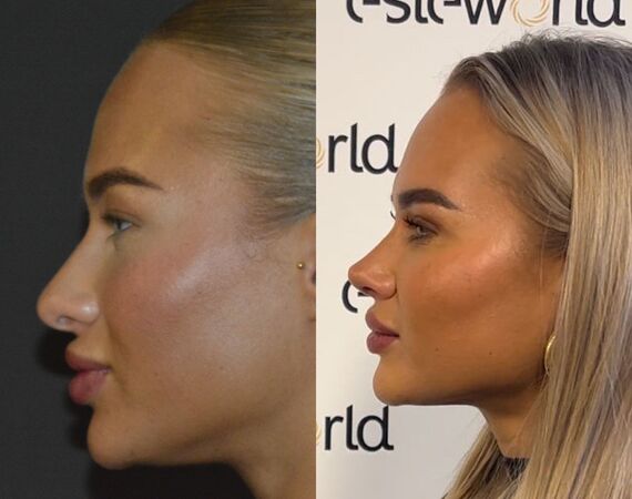 Neuscorrectie Istanbul