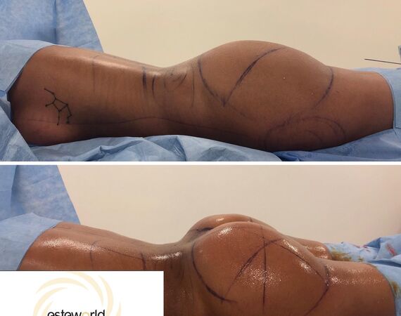 Braziliaanse bilvergroting Turkije