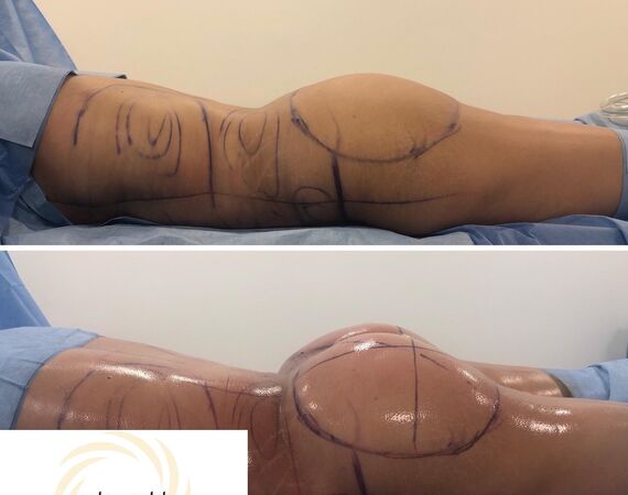 Braziliaanse bilvergroting Turkije