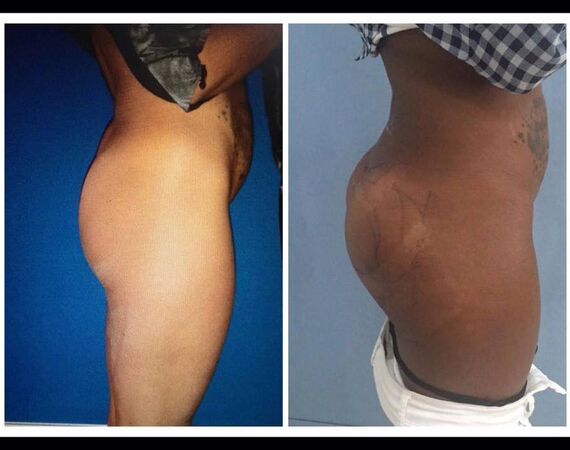 Braziliaanse bilvergroting Istanbul