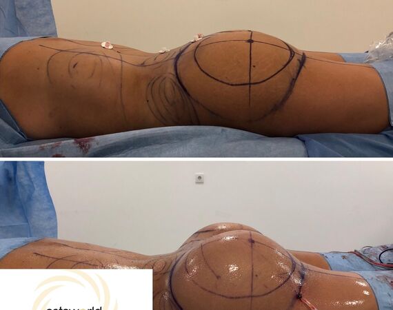 Braziliaanse bilvergroting Istanbul