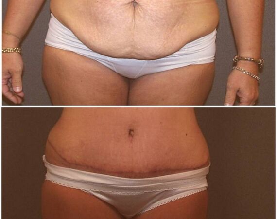 Mini-buikwandcorrectie Turkije