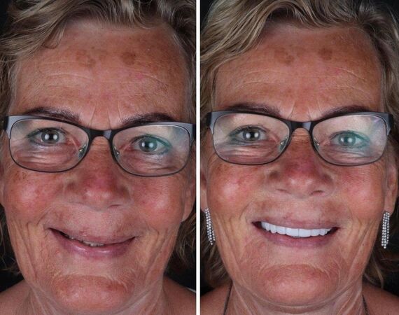 Bruggen behandeling Turkije