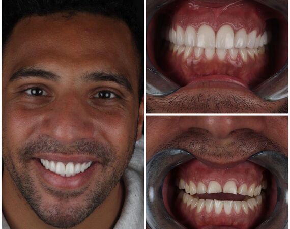 Gebits-makeover Istanbul