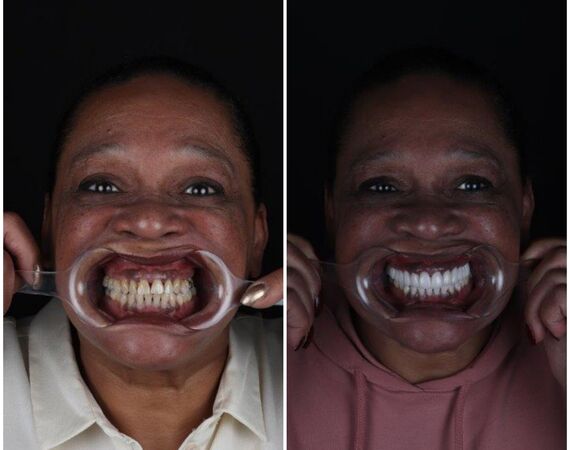 Vaste gebitsprothese Istanbul