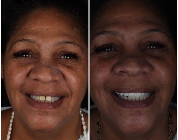 Vaste gebitsprothese Istanbul