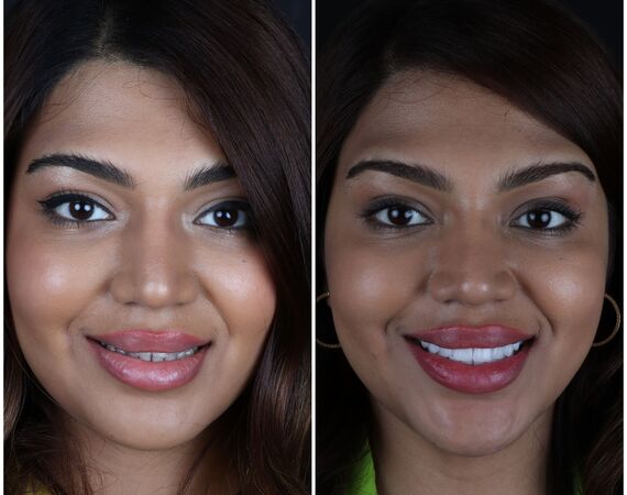 Vaste gebitsprothese Istanbul