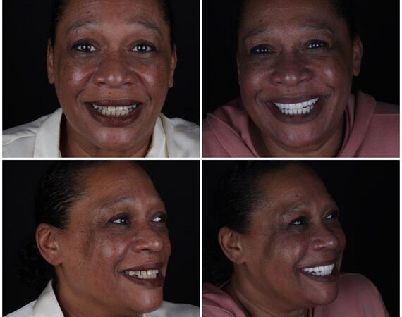 Vaste gebitsprothese Istanbul