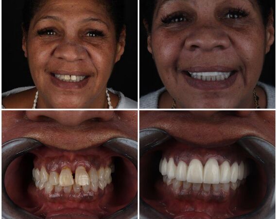 Vaste gebitsprothese Istanbul