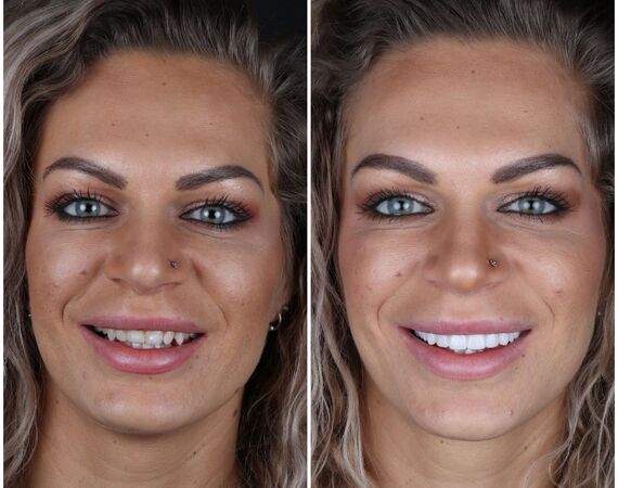 Vaste gebitsprothese Turkije