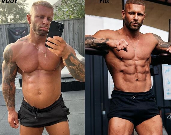 René Spoelstra voor gynaecomastie bij Esteworld