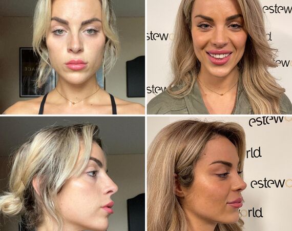 Influencer @eilishflesch voor Neuscorrectie naar Esteworld