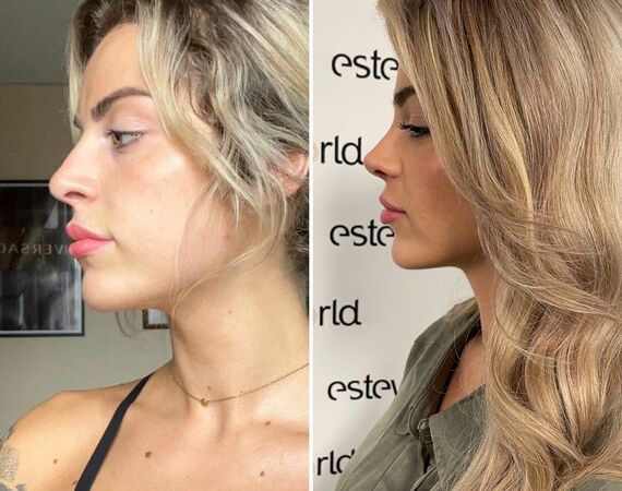 Influencer @eilishflesch voor Neuscorrectie naar Esteworld