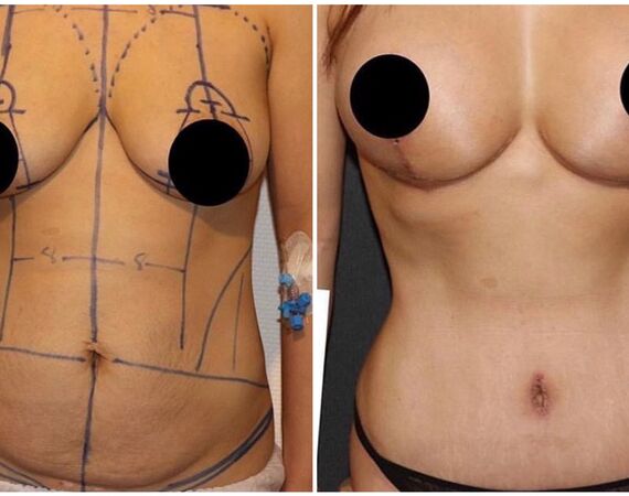 Mommy makeover Turkije