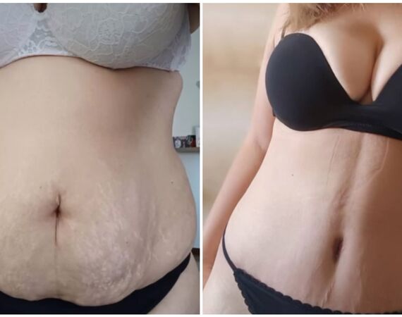 Mommy makeover Turkije