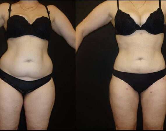 Mommy makeover Turkije