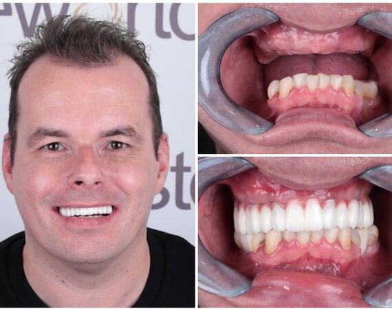 Tandarts Turkije: Een overzicht van de voordelen en nadelen