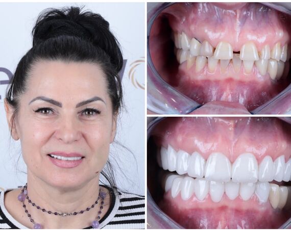 Tandarts Turkije: Een overzicht van de voordelen en nadelen