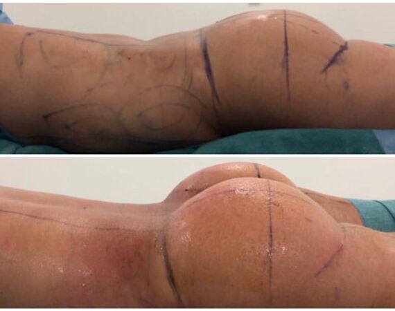 BBL in Turkije: Kan dat mislukken?