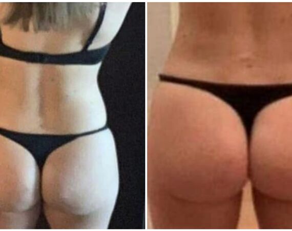 BBL in Turkije: Kan dat mislukken?