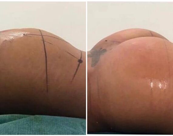 BBL in Turkije: Kan dat mislukken?