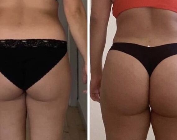 BBL in Turkije: Kan dat mislukken?