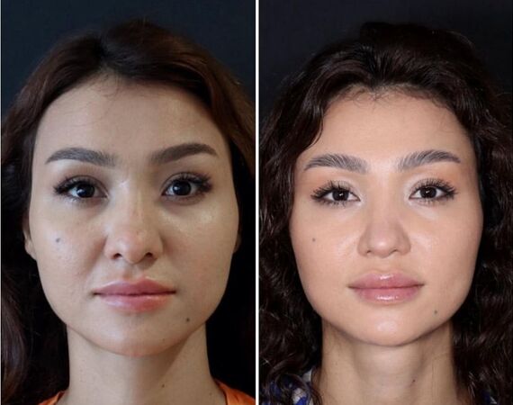 Veelgestelde Vragen over Neuscorrectie in Turkije