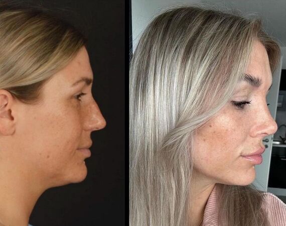 Veelgestelde Vragen over Neuscorrectie in Turkije