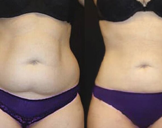 Veelgestelde Vragen over Buikwandcorrectie in Turkije