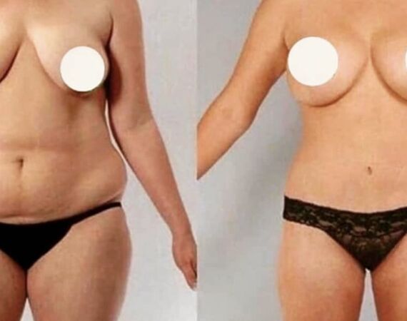 Veelgestelde Vragen over Buikwandcorrectie in Turkije