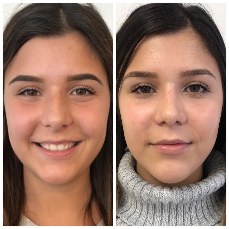 Had ik neuscorrectie maar eerder gedaan!