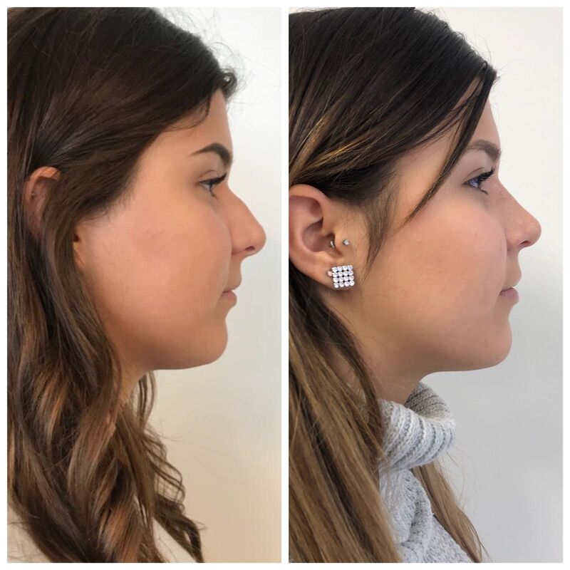 Had ik neuscorrectie maar eerder gedaan!