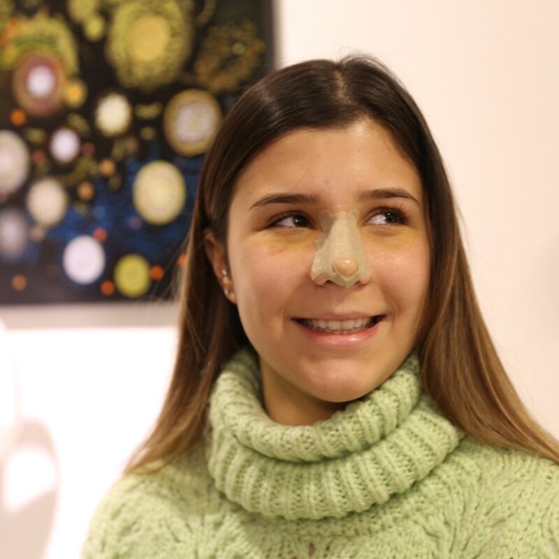 Had ik neuscorrectie maar eerder gedaan!