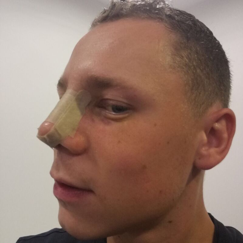 Stef neuscorrectie Turkije