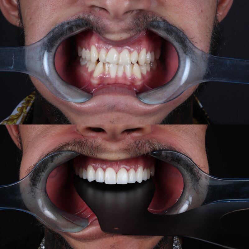 2 broers voor Glamoursmile bij Esteworld