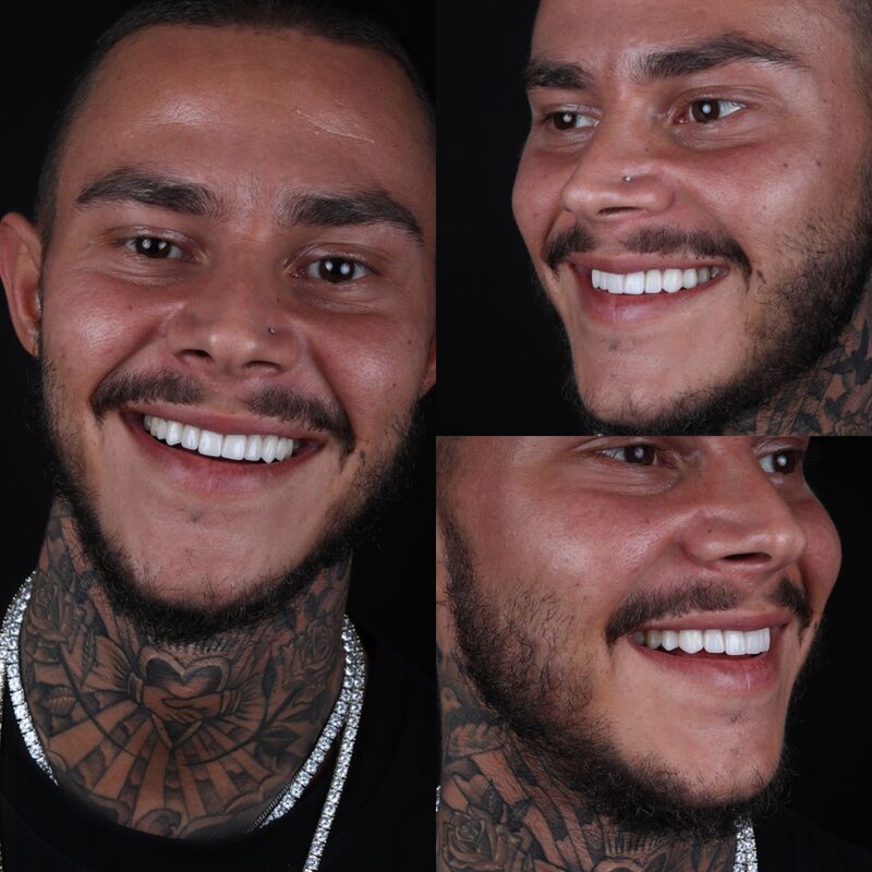 2 broers voor Glamoursmile bij Esteworld