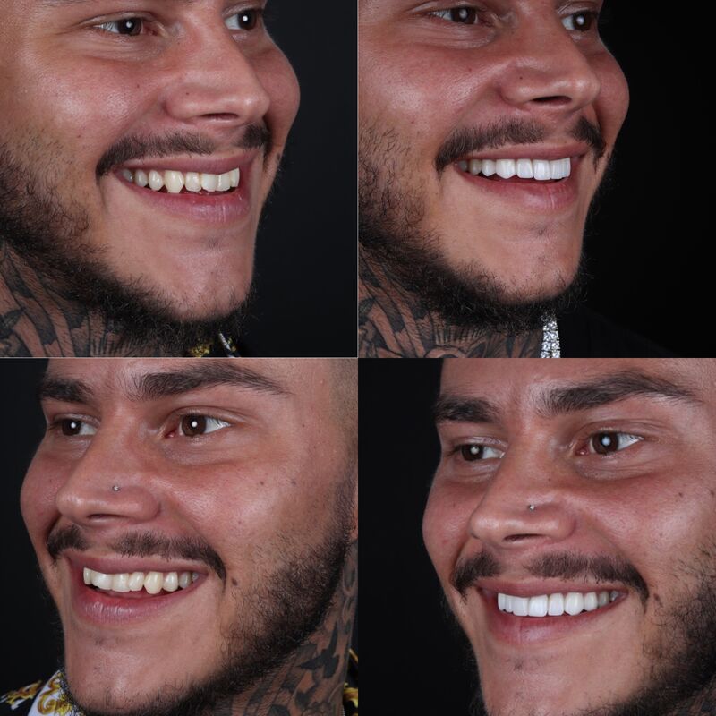 2 broers voor Glamoursmile bij Esteworld