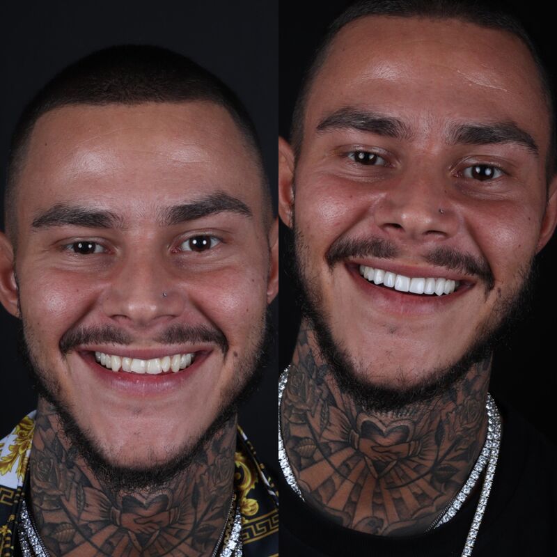 2 broers voor Glamoursmile bij Esteworld