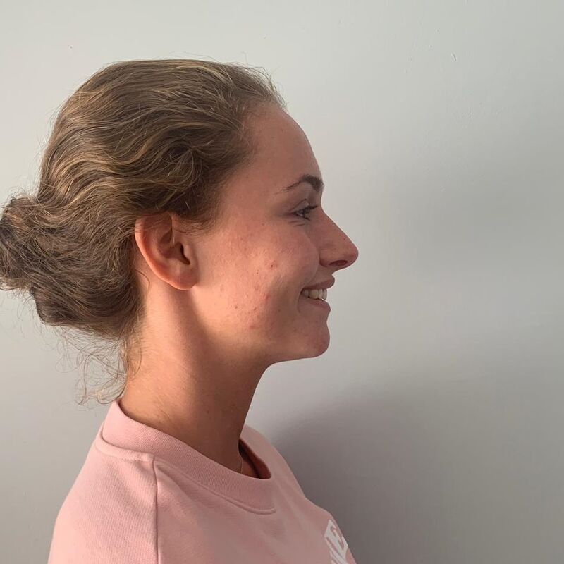 Marielle, voor een neuscorrectie moet je bij Esteworld zijn.