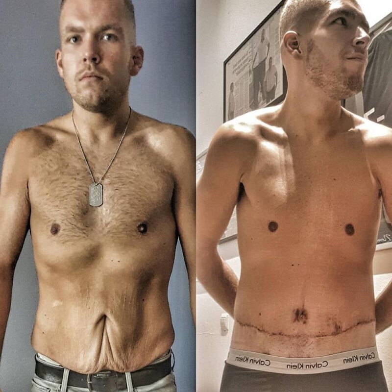 Joris, Buikwandcorrectie na 90 kilo vetverlies.