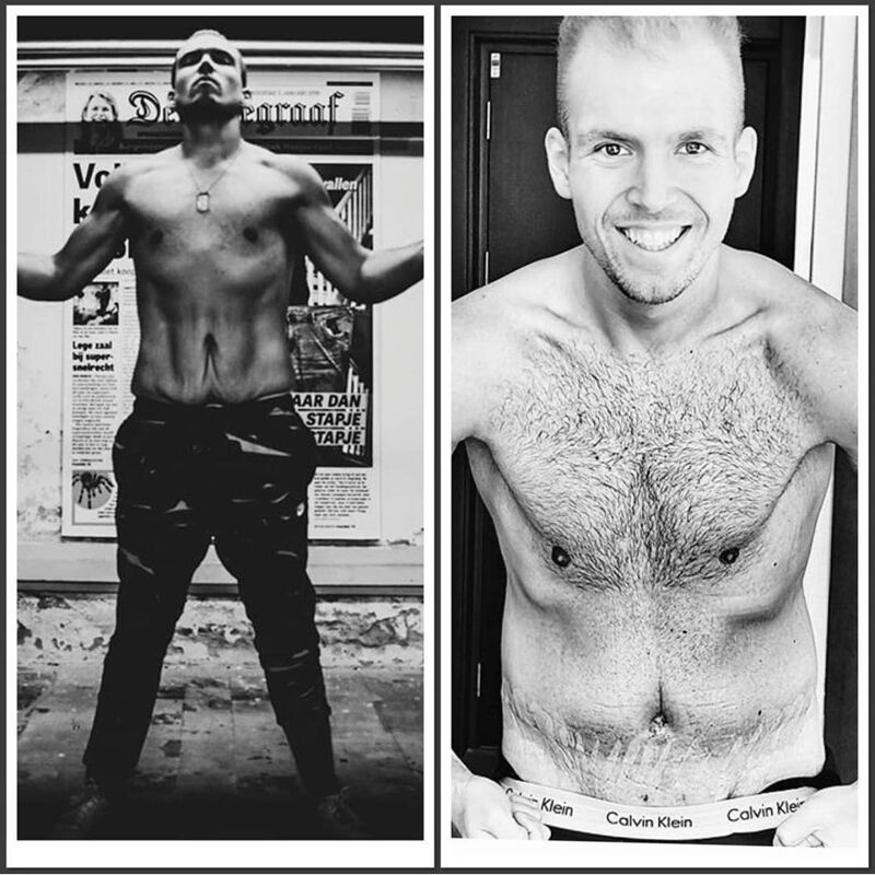 Joris, Buikwandcorrectie na 90 kilo vetverlies.