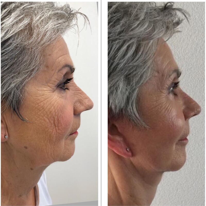 Verbluffende facelift Turkije