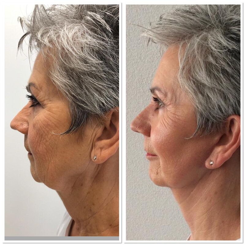 Verbluffende facelift Turkije