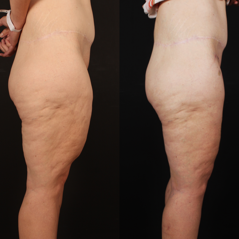 Lennie, beenlift bij Esteworld