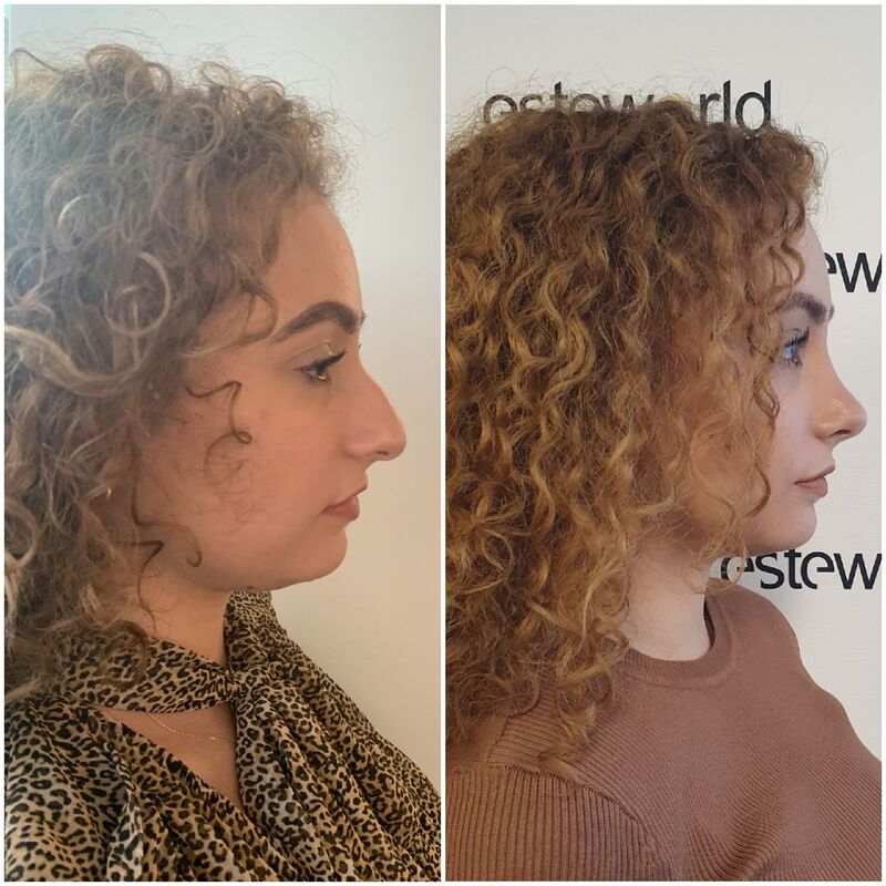 Betul super blij met neuscorrectie