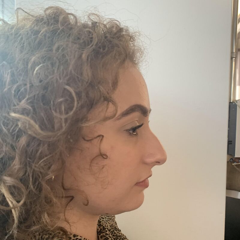 Betul super blij met neuscorrectie