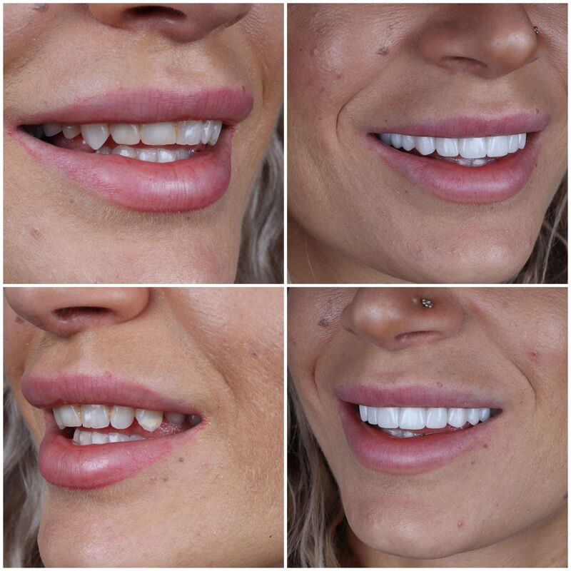 @EvelienNellen voor kronen en facings naar Turkije