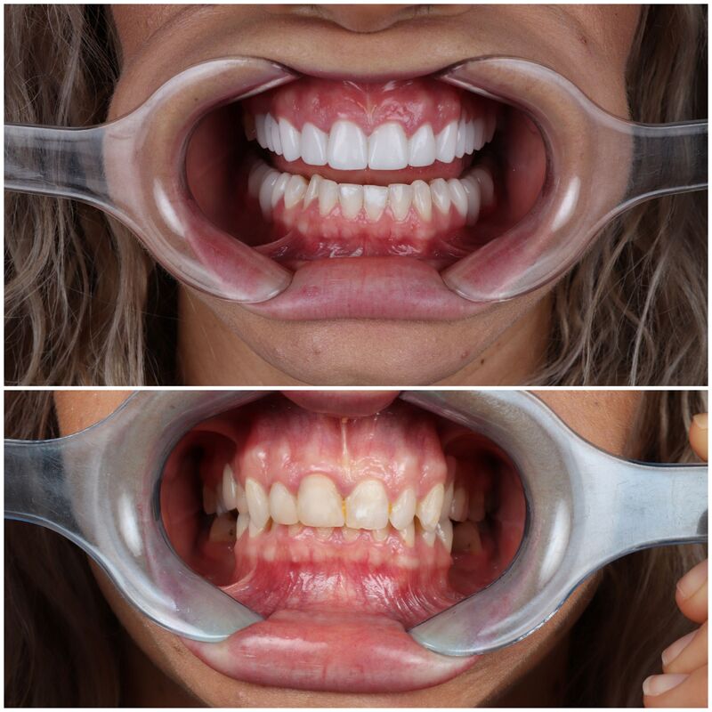 @EvelienNellen voor kronen en facings naar Turkije